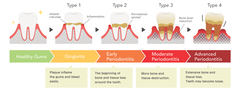 Four stages of Periodontitis Infographic Infographic showing simplified drawings Periodontal Gum Disease categories – from healthy, gingivitis, early periodontitis, moderate periodontitis to advanced periodontitis.