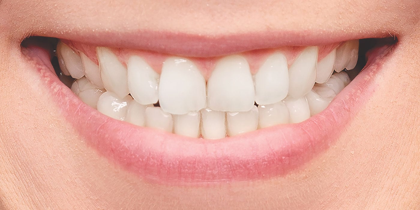 Aesthetic Dentistry Teeth Whitening | After Image