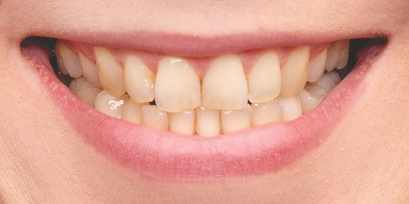 Aesthetic Dentistry Teeth Whitening | Before Image