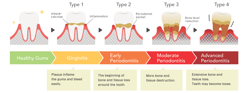 Infographic showing simplified drawings Periodontal Gum Disease categories – from healthy, gingivitis, early periodontitis, moderate periodontitis to advanced periodontitis.